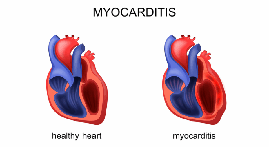 cuore, miocardite