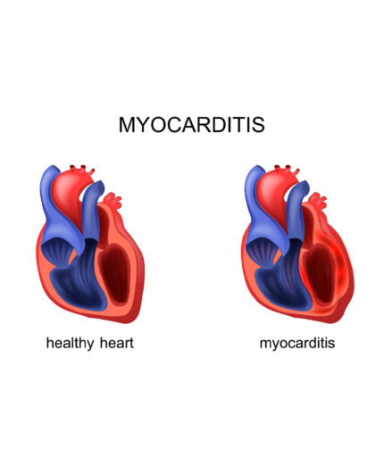 cuore, miocardite