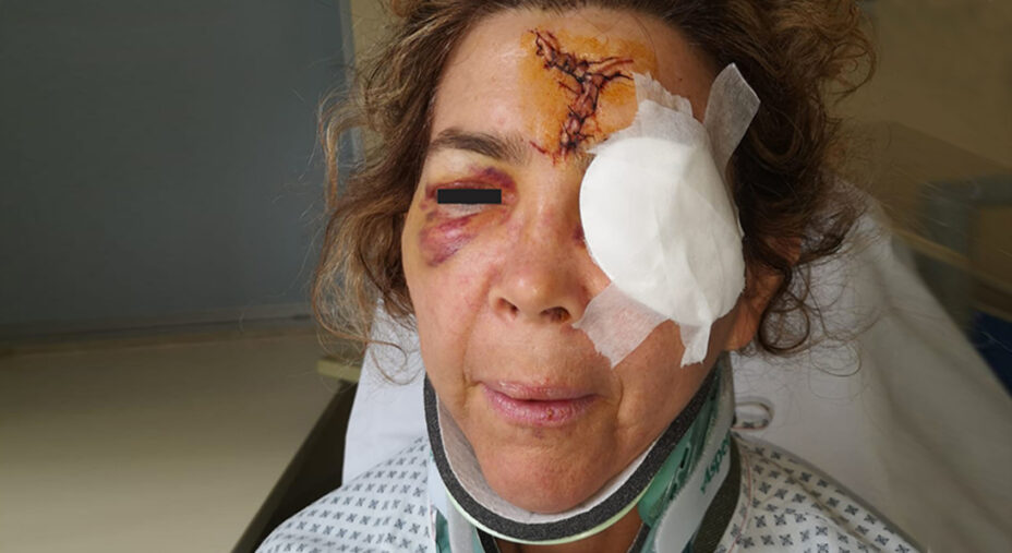 L'urto è stato frontale e anche impossibile da evitare: Katia ne porta i segni