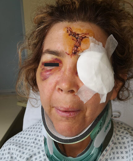 L'urto è stato frontale e anche impossibile da evitare: Katia ne porta i segni