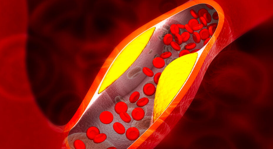 Il colesterolo in eccesso, soprattutto quello LDL ("cattivo"), può bloccare le arterie, ostacolando il flusso sanguigno e aumentando il rischio di eventi gravi come infarti e ictus (depositphotos.com)