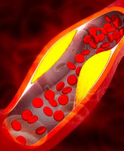 Il colesterolo in eccesso può bloccare le arterie, ostacolando il flusso sanguigno e aumentando il rischio di eventi gravi come infarti e ictus (depositphotos.com)