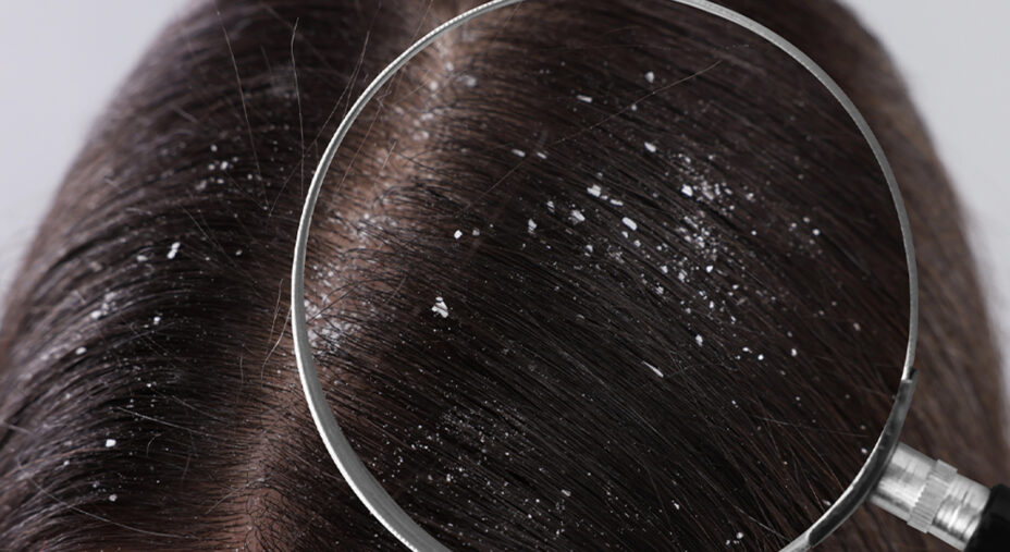 La forfora è la normale desquamazione del cuoio capelluto, ma quaneo questo è irritato, il fenomeno aumenta (depositphotos.com)