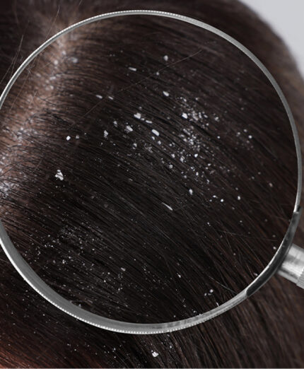 La forfora è la normale desquamazione del cuoio capelluto, ma quaneo questo è irritato, il fenomeno aumenta (depositphotos.com)