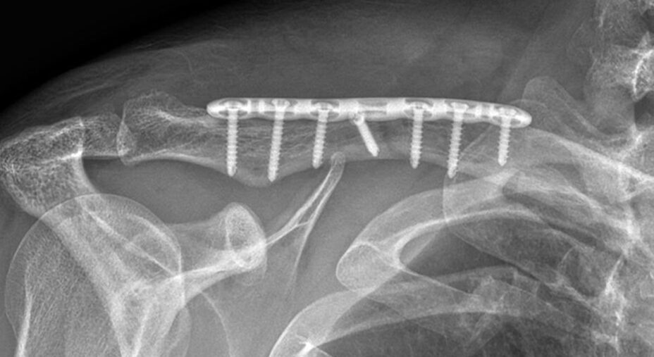 Negli adulti è preferibile ridurre e sintetizzare la frattura di clavicola con una placca in titanio e le relative viti