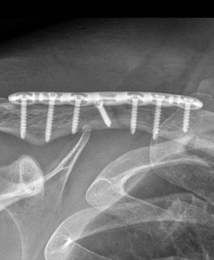 Negli adulti è preferibile ridurre e sintetizzare la frattura di clavicola con una placca in titanio e le relative viti